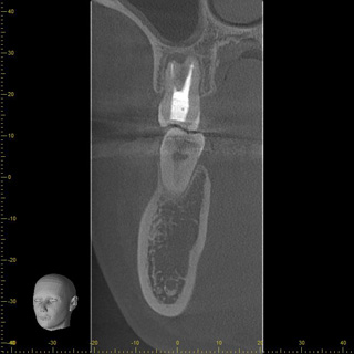 歯科用CT