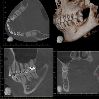 歯科用CT